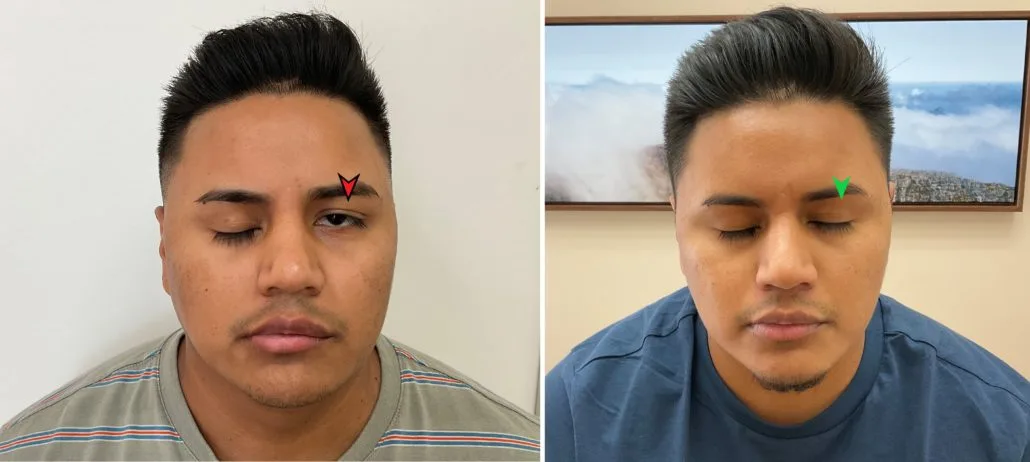 Patient closing eyes — before and after 1 month of Bell's Palsy acupuncture treatment