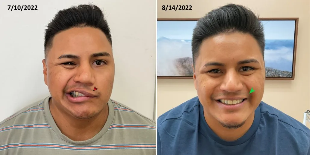 Patient smiling — before and after 1 month of Bell's Palsy acupuncture treatment