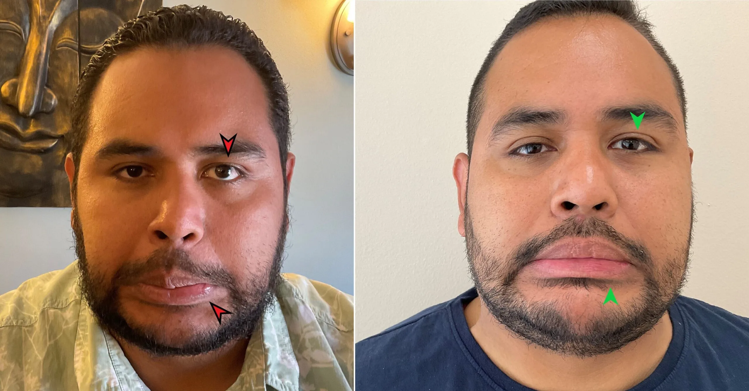Patient Cesar frowning — before and after 2 months of Bell's Palsy acupuncture treatment