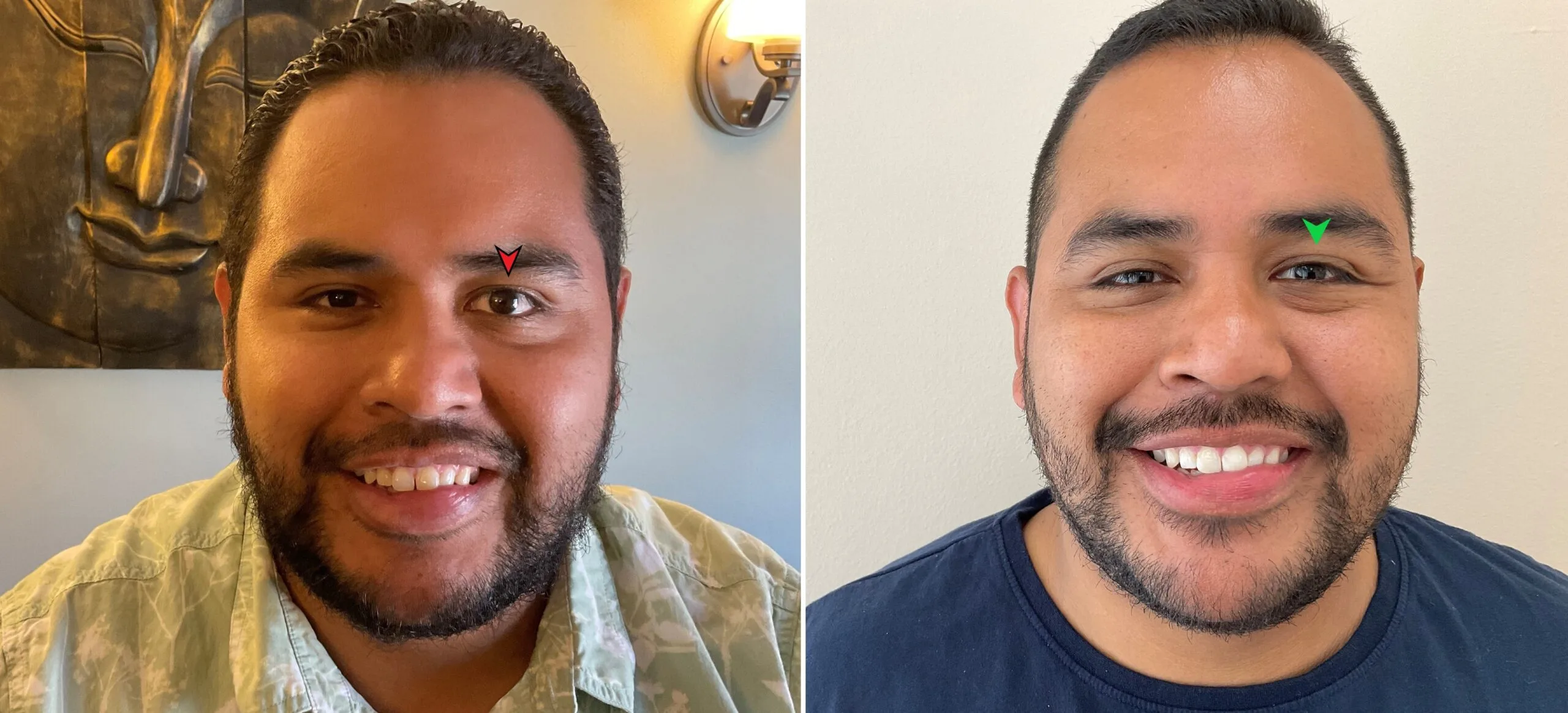 Patient Cesar smiling — before and after 2 months of Bell's Palsy acupuncture treatment