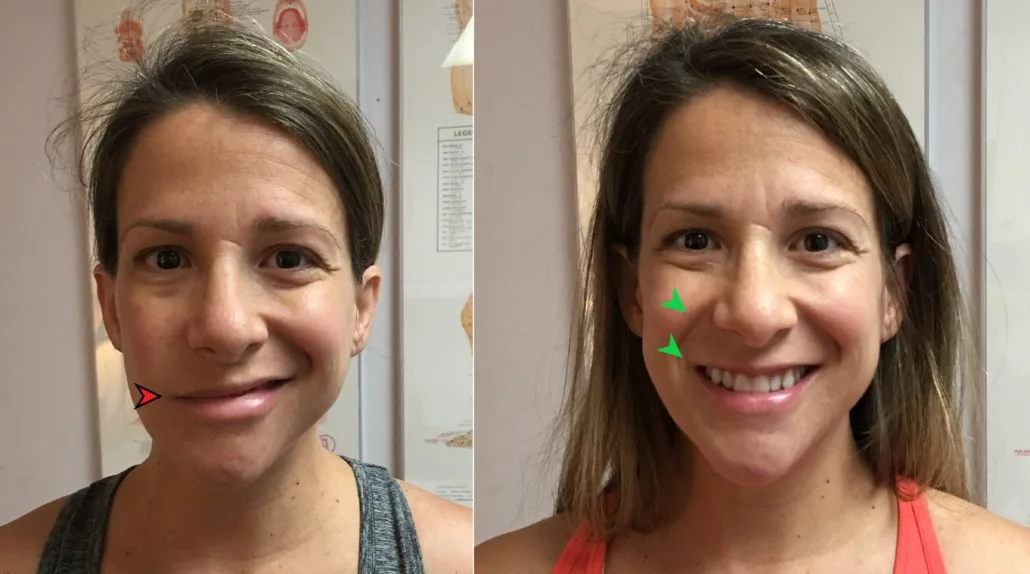 Patient — before and after 2 weeks of Bell's Palsy acupuncture treatment
