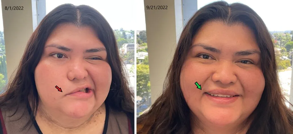 Patient T smiling — before and after 1.5 months of Bell's Palsy acupuncture treatment