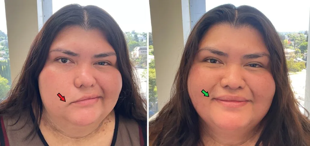 Patient T smiling (angle 2) — before and after 1.5 months of Bell's Palsy acupuncture treatment